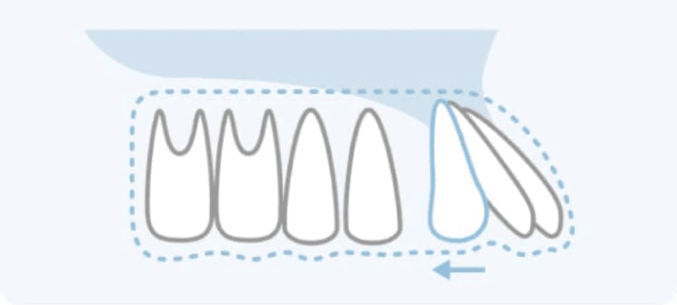 キレイライン矯正が歯を動かす仕組み