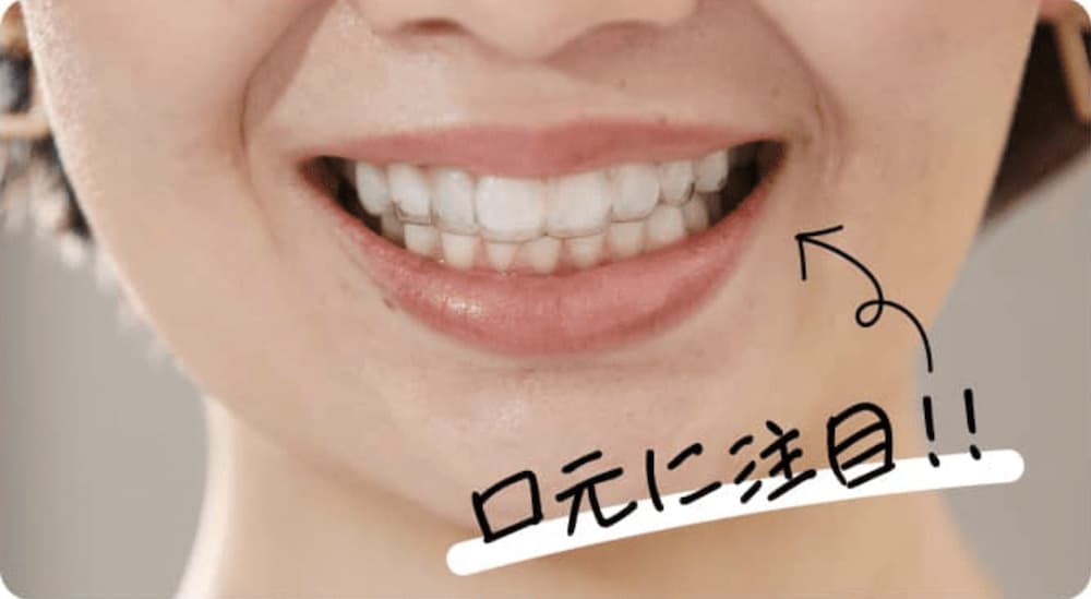 キレイライン矯正の見た目