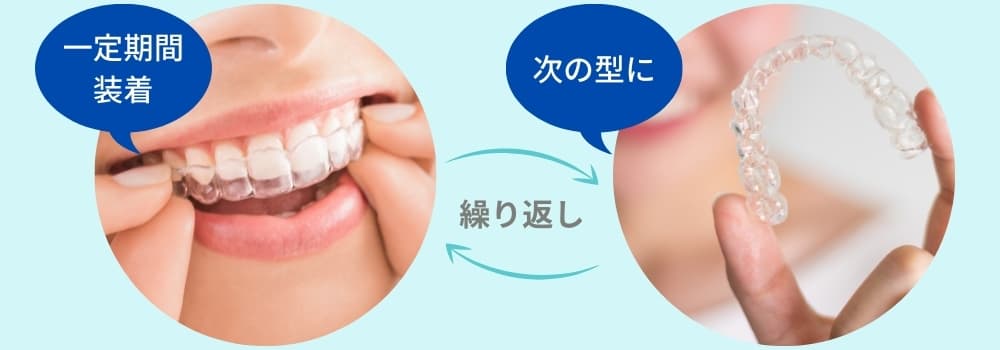 マウスピース矯正の説明