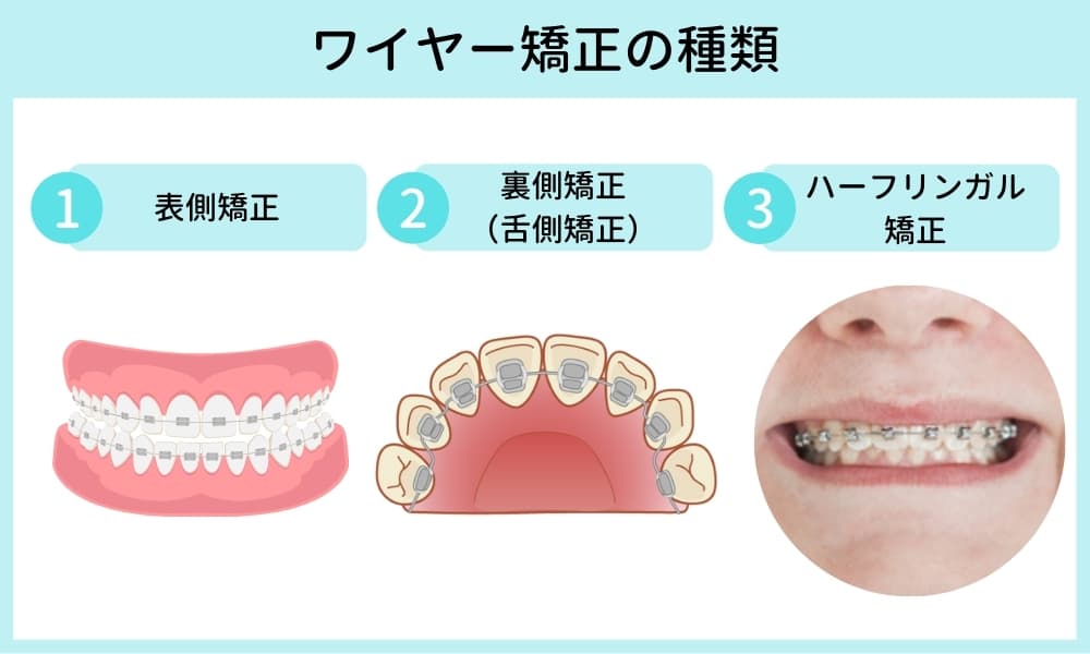 図解_ワイヤー矯正の種類