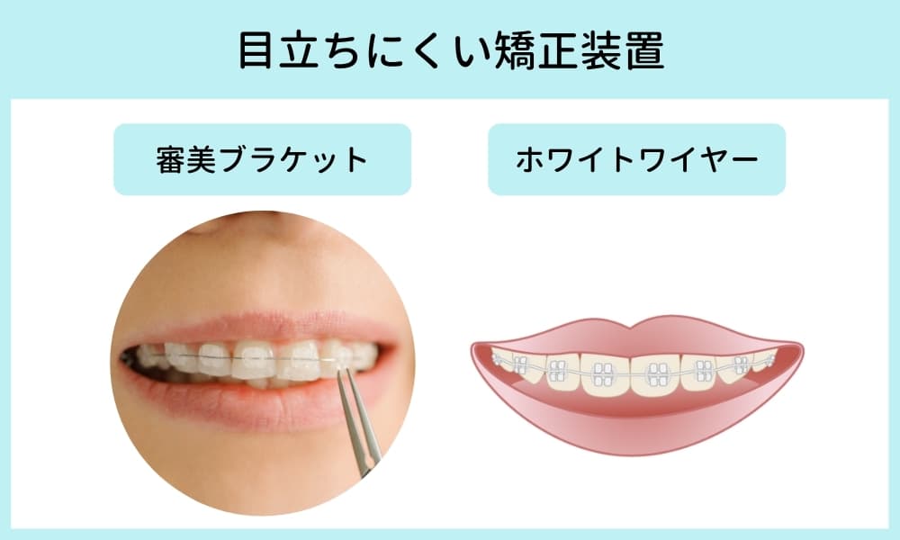 図解_目立ちにくい矯正装置
