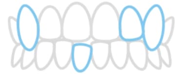 ガタガタ・八重歯のイラスト