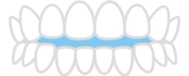 閉じない前歯のイラスト